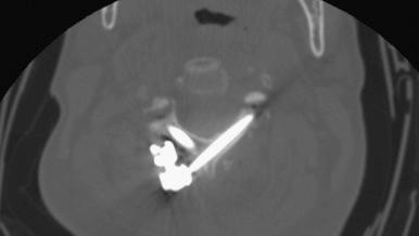 FIGURE 41-1, Axial computed tomography scan of bilateral C2 translaminar screws.