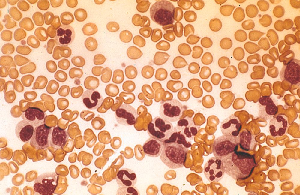 FIGURE 170-2, Chronic myeloid leukemia, chronic phase.