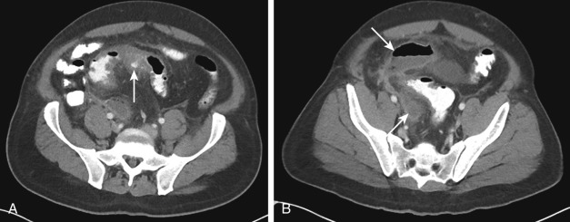 Figure 32-1, Acute sigmoid diverticulitis with abscess formation on CT. A, Axial contrast-enhanced CT image through pelvis shows wall thickening and enhancement of sigmoid diverticulum ( arrow ), segmental wall thickening of adjacent sigmoid colon, and pericolic fat stranding. B, Axial contrast-enhanced CT image more inferiorly through pelvis demonstrates two loculated fluid collections ( arrows ) with thick enhancing rims in right pelvis, one of which contains gas, in keeping with abscesses.