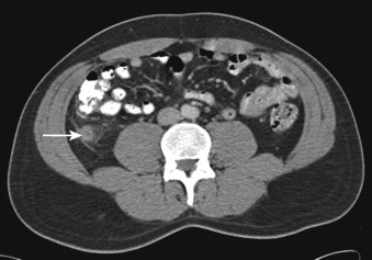 Figure 32-2, Acute appendicitis on CT. Axial contrast-enhanced CT image through lower abdomen reveals wall thickening and dilation of appendix ( arrow ) with periappendiceal inflammatory fat stranding.