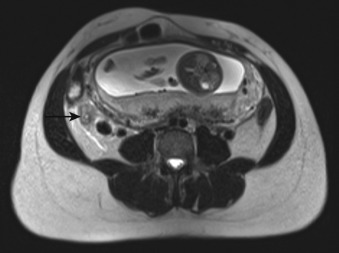 Figure 32-3, Acute appendicitis in setting of pregnancy on MRI. Axial T2-weighted MR image through lower abdomen shows wall thickening of appendix ( arrow ) with periappendiceal edema. Note intrauterine gestation as well.