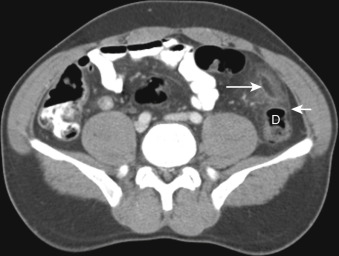 Figure 32-4, PEA on CT. Axial contrast-enhanced CT image through pelvis demonstrates small oval pedunculated fat attenuation structure with soft tissue enhancing rim ( long arrow ) and surrounding inflammatory fat stranding adjacent to descending colon ( D ). Also note thickening of adjacent parietal peritoneum ( short arrow ) secondary to reactive peritonitis.