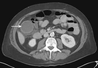Figure 32-5, Acute cholecystitis on CT. Axial contrast-enhanced CT image through abdomen reveals wall thickening and distention of gallbladder ( arrow ) along with pericholecystic inflammatory fat stranding.