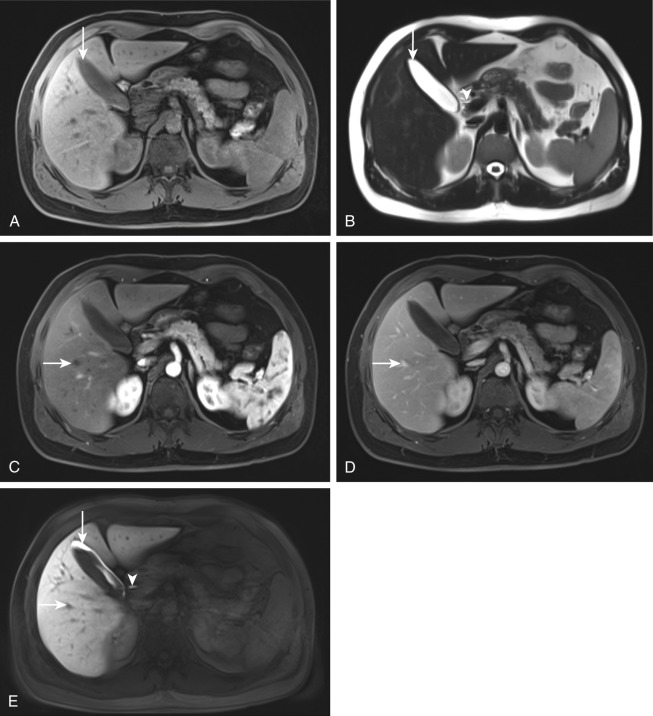 Figure 28-1, Normal liver on MRI. A, Axial fat-suppressed T1-weighted MR image through abdomen shows high signal intensity of liver relative to spleen. Note normal low signal intensity fluid within gallbladder ( arrow ). B, Axial heavily T2-weighted MR image through abdomen demonstrates low signal intensity of liver relative to spleen. Note normal very high signal intensity fluid within thin-walled gallbladder ( arrow ) and extrahepatic bile duct ( arrowhead ). C, Axial late arterial phase contrast-enhanced fat-suppressed T1-weighted MR image through abdomen shows enhancement of arteries and portal veins but lack of enhancement of hepatic veins ( arrow ). D, Axial venous phase contrast-enhanced fat-suppressed T1-weighted MR image through abdomen now demonstrates enhancement of liver parenchyma and portal veins as well as of hepatic veins ( arrow ). E, Axial hepatobiliary phase contrast-enhanced fat-suppressed T1-weighted MR image through abdomen shows persistent enhancement of liver parenchyma relative to skeletal muscle and excretion of contrast material into gallbladder ( long arrow ) and extrahepatic bile duct ( arrowhead ) but lack of enhancement of hepatic vessels including hepatic veins ( short arrow ).