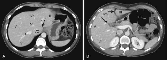 Figure 28-2, Normal segmental anatomy of liver on CT. A, Axial contrast-enhanced CT image through liver above plane of portal vein shows right ( R ), middle ( M ), and left ( L ) hepatic veins between hepatic segments that drain to inferior vena cava ( IVC ). Note fissure for ligamentum venosum ( arrow ) anterior to caudate lobe ( I ), as well as lateral ( II ), medial ( IVa ), anterior ( VIII ), and posterior ( VII ) segments. B, Axial contrast-enhanced CT image through liver below plane of portal vein shows left intersegmental fissure ( short arrow ) and interlobar fissure ( long arrow ), as well as lateral ( III ), medial ( IVb ), anterior ( V ), and posterior ( VI ) segments.