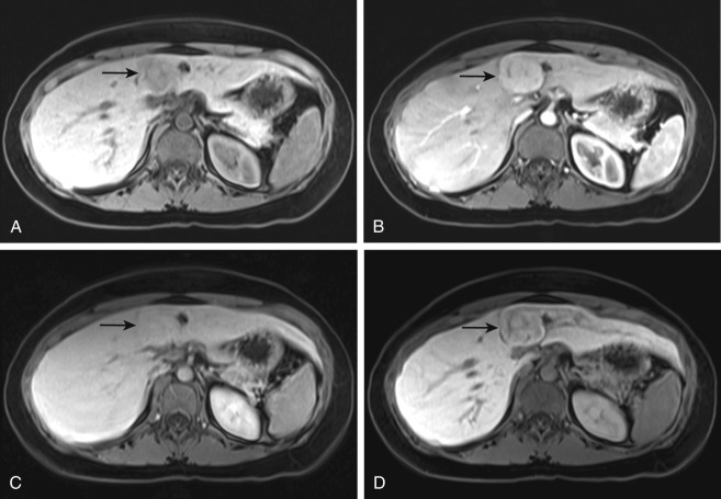 Figure 28-3, FNH on MRI. A, Axial fat-suppressed T1-weighted MR image through liver shows hepatic lesion ( arrow ) that is slightly hypointense-isointense in signal intensity relative to liver parenchyma. B, Axial arterial phase, C, Axial venous phase, and D, Axial hepatobiliary phase contrast-enhanced MR images through liver show that hepatic lesion ( arrow ) has intense homogeneous arterial phase enhancement, venous phase enhancement similar to liver parenchyma, and hepatobiliary phase retained enhancement similar to liver parenchyma.
