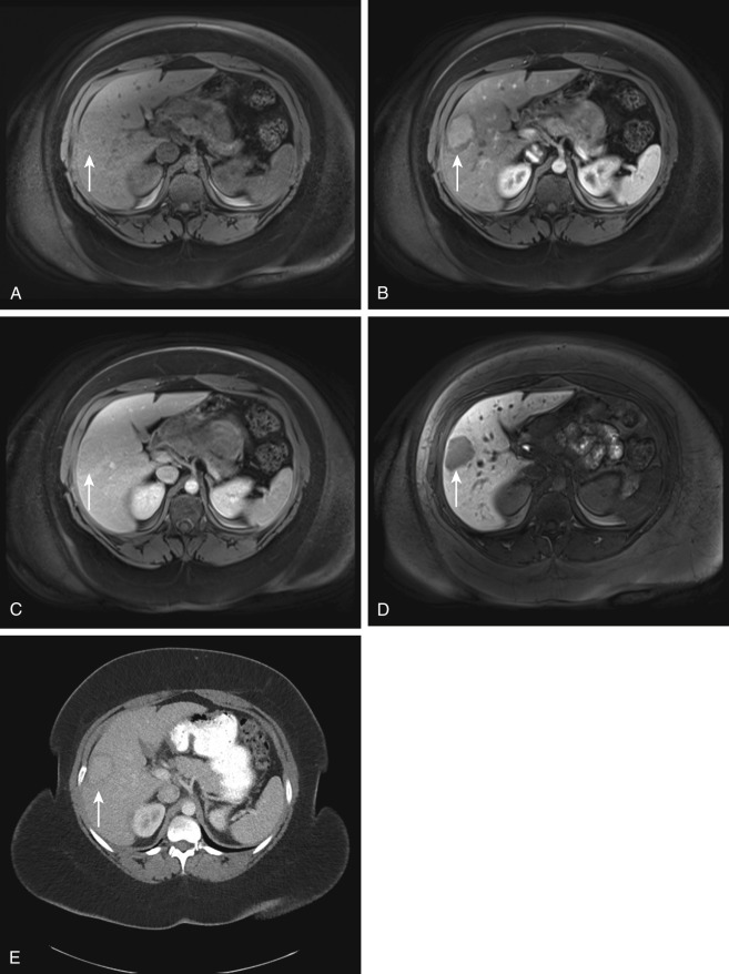 Figure 28-4, Hepatic adenoma on MRI and CT. A, Axial fat-suppressed T1-weighted MR image through liver shows hepatic lesion ( arrow ) that is slightly hypointense-isointense in signal intensity relative to liver parenchyma. B, Axial arterial phase, C, Axial venous phase, and D, Axial hepatobiliary phase contrast-enhanced MR images through liver show that hepatic lesion ( arrow ) has moderate heterogeneous arterial phase enhancement, mild venous phase washout relative to liver parenchyma, and hepatobiliary phase hypointense signal intensity relative to liver parenchyma. E, Axial arterial phase contrast-enhanced CT image through liver again reveals that hepatic lesion ( arrow ) has moderate heterogeneous arterial phase enhancement.