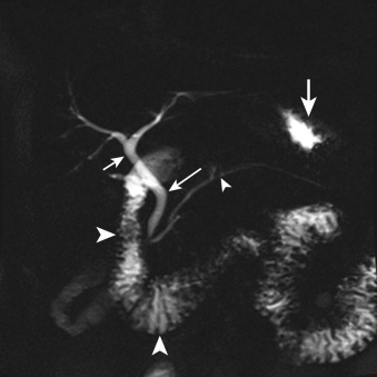 Figure 30-1, Normal MRCP. Coronal MRCP image shows normal caliber main pancreatic duct (small arrowhead), common bile duct ( long thin arrow ), and common hepatic duct ( short thin arrow ). Also note fluid-filled stomach ( thick arrow ) and duodenum ( large arrowheads ).