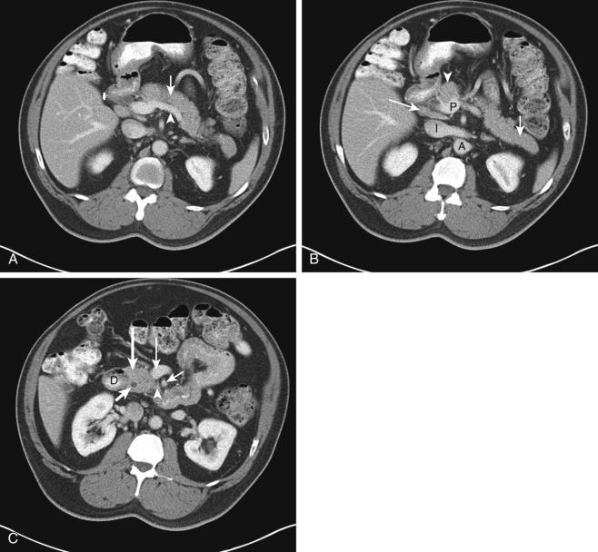 Figure 30-2, Normal pancreas on CT. A, Axial contrast-enhanced CT image through abdomen shows pancreatic body ( arrow ) located anterior to splenic vein ( arrowhead ). B, Axial contrast-enhanced CT image more inferiorly demonstrates pancreatic neck ( arrowhead ) located anterior to portal vein confluence ( P ) along with pancreatic tail ( short arrow ). Note normal size portacaval lymph node ( long arrow ) in portacaval space between portal vein confluence ( P ) and inferior vena cava ( I ). Abdominal aorta ( A ) is also visualized. C, Axial contrast-enhanced CT image even more inferiorly reveals pancreatic head ( long thick arrow ) located medial to 2nd portion of duodenum ( D ) and uncinate process ( arrowhead ) which is posteriorly located to proximal SMV ( long thin arrow ) and SMA ( short thin arrow ). Note common bile duct ( short thick arrow ) passing through right posterolateral aspect of pancreatic head.