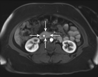 Figure 30-3, Annular pancreas on MRI. Axial contrast-enhanced T1-weighted MR image through abdomen shows high signal intensity pancreatic parenchyma ( arrows ) completely surrounding 2nd portion of duodenum (*).