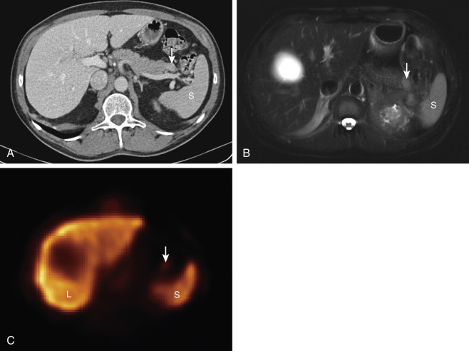 Figure 30-4, Intrapancreatic splenule on CT, MRI, and 99m Tc sulfur colloid single photon emission computed tomography (SPECT). A, Axial contrast-enhanced CT image through abdomen shows ovoid well-circumscribed enhancing structure in pancreatic tail ( arrow ) with similar attenuation as spleen ( S ). B, Axial fat-suppressed T2-weighted image similarly shows that pancreatic tail structure ( arrow ) has similar signal intensity as spleen ( S ). C, Axial 99m Tc sulfur colloid SPECT image reveals radiotracer uptake in structure ( arrow ) confirming presence of reticuloendothelial tissue composition and therefore of diagnosis of intrapancreatic splenule. Note normal radiotracer uptake in liver ( L ) and spleen ( S ) and round photopenic area in liver due to cyst.