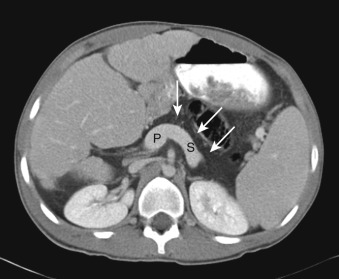 Figure 30-5, Diffuse pancreatic fatty replacement secondary to cystic fibrosis on CT. Note fat attenuation of pancreatic body and tail ( arrows ) located anterior to splenic vein ( S ), which connects to portal vein confluence ( P ).