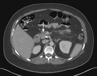 Figure 30-6, Focal fatty replacement on CT. Note geographic low attenuation area in anterior pancreatic head ( arrow ) with well-defined demarcation from triangular area of fatty sparing in posterior pancreatic head ( arrowhead ).