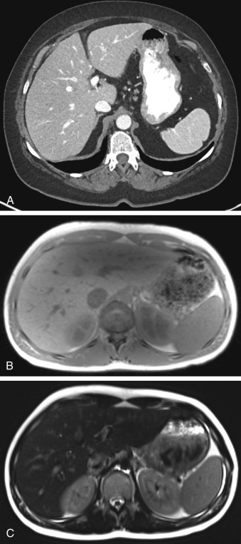 Figure 29-1, A, Normal spleen on CT. Note homogeneous attenuation of spleen along with smooth curvilinear infolding of lateral splenic surface without surrounding fluid due to splenic cleft. B, Normal spleen on T1-weighted MRI. Note slight hypointense signal intensity of spleen relative to liver. C, Normal spleen on T2-weighted MRI. Note hyperintense signal intensity of spleen relative to liver.