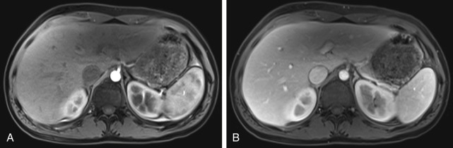 Figure 29-2, A, Normal arterial phase enhancement of spleen on MRI. Note arciform enhancement pattern of spleen with alternating bands of low and high signal intensity. B, Normal venous phase enhancement of spleen on MRI. Note homogeneous enhancement of spleen.