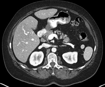 Figure 29-3, Splenule on CT. Note 2-cm discrete round focus of splenic tissue with identical attenuation as spleen located more laterally.