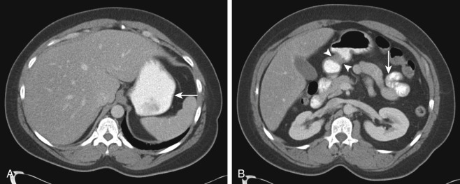 Figure 25-1, Normal upper GI tract on CT. A, Axial contrast-enhanced CT image through upper abdomen shows normal thickness (≤3 mm) of gastric body wall ( arrow ). Note moderate distention of stomach by positive oral contrast material. B, Axial contrast-enhanced CT image more inferiorly through abdomen shows normal thicker wall of gastric pylorus ( arrowheads ) as well as normal (≤3 mm in thickness) wall of well-distended loop of jejunum ( arrow ).