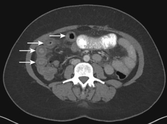 Figure 25-2, “Target” sign of small bowel on CT. Note moderate wall thickening of multiple loops of small bowel ( arrows ) in right abdomen and mild perienteric fat stranding. Also note associated bright soft tissue attenuation inner layer, dark low-attenuation middle layer (secondary to submucosal edema), and bright soft tissue attenuation outer layer representing “target” sign. In small bowel, presence of “target” sign is highly specific for nonneoplastic disease. This patient presented with acute abdominal pain caused by small bowel angioedema secondary to angiotensin converting enzyme (ACE) inhibitor drug therapy.