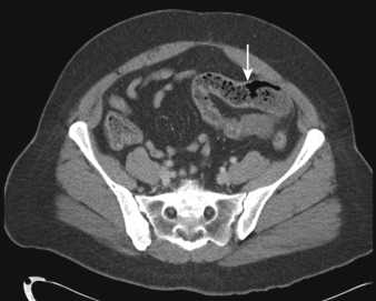 Figure 25-3, “Small bowel feces” sign of small bowel on CT. Note particulate debris and gas bubbles with mildly dilated loop of small bowel ( arrow ) mimicking appearance of fecal material in large bowel related to low-grade partial small bowel obstruction secondary to nonvisualized adhesions.