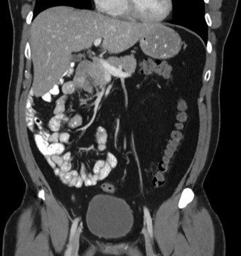 Figure 25-4, Bowel malrotation on CT. Note predominance of small bowel loops in right abdomen and of large bowel loops in left abdomen.