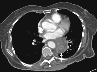 Figure 25-5, Esophagitis on CT. Note marked smooth circumferential wall thickening of esophagus ( arrow ) along with “target” sign and luminal narrowing.