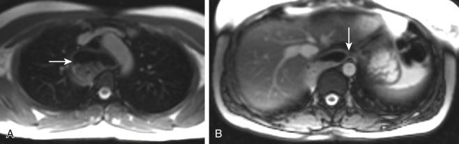 Figure 25-6, Primary achalasia on MRI. A, Axial bright-blood MR image through upper chest shows marked dilation of upper esophagus ( arrow ) with layering retained ingested debris. B, Axial bright-blood MR image through lower chest demonstrates smooth tapered narrowing of distal esophagus ( arrow ). Note absence of associated soft tissue mass.