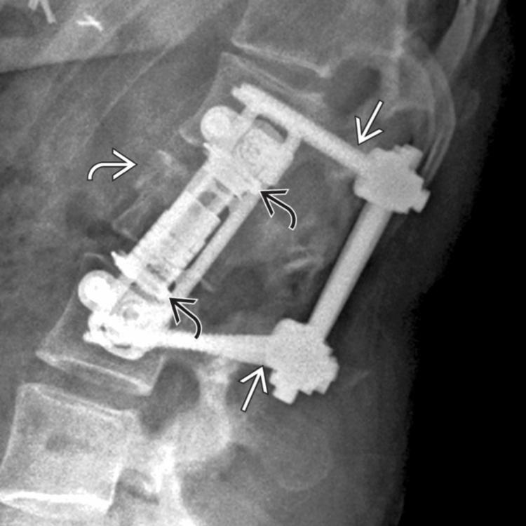 Lateral radiograph displays an L2 burst fracture . Synex expandable cage extends from L1-L3 with bilateral L1 and L3 pedicle screws . The goals of surgery include decompressing neural elements, restoring vertebral body height, correcting angular deformity, and stabilizing columns of spine.