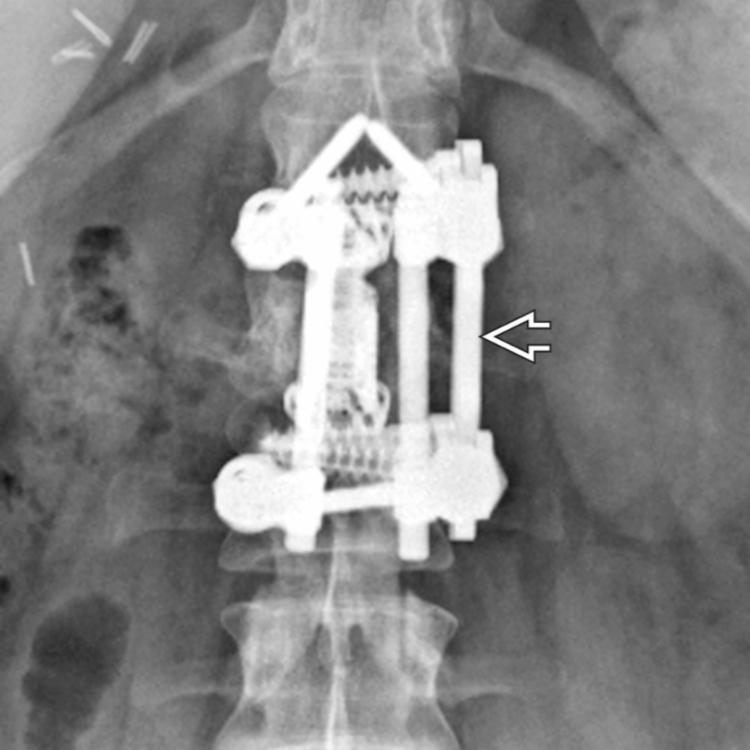 AP radiograph shows an expandable cage and lateral construct , which provides intervertebral distraction, ↑ anterior column height, and ↓ additional stress across pedicle screw constructs.