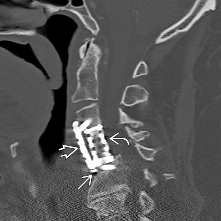 Sagittal CT shows cage spanning the C4-C5 levels . ACDF is noted from C3-C5 . There is collapse of the C5 endplate with subsidence of anterior plate/screw construct and cage . Kyphosis is present at C6-C7.