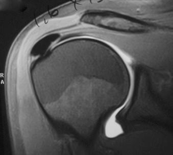 FIGURE 16.6, Magnetic resonance imaging of calcific tendinopathy.