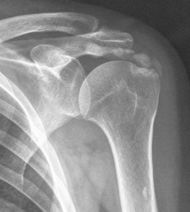 FIG. 17A.1, Rotator cuff calcific tendinopathy.