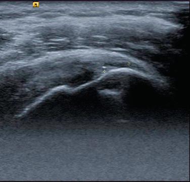 FIG. 17A.2, Ultrasound imaging of calcific tendinopathy of the supraspinatus tendon.