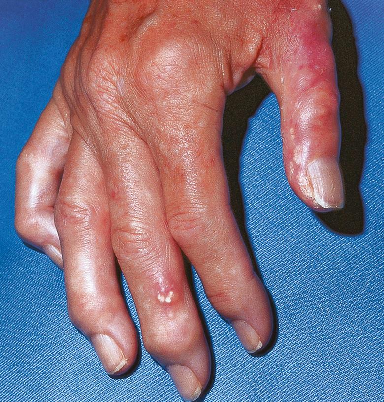 Fig. 50.1, Dystrophic calcification in a patient with CREST syndrome.