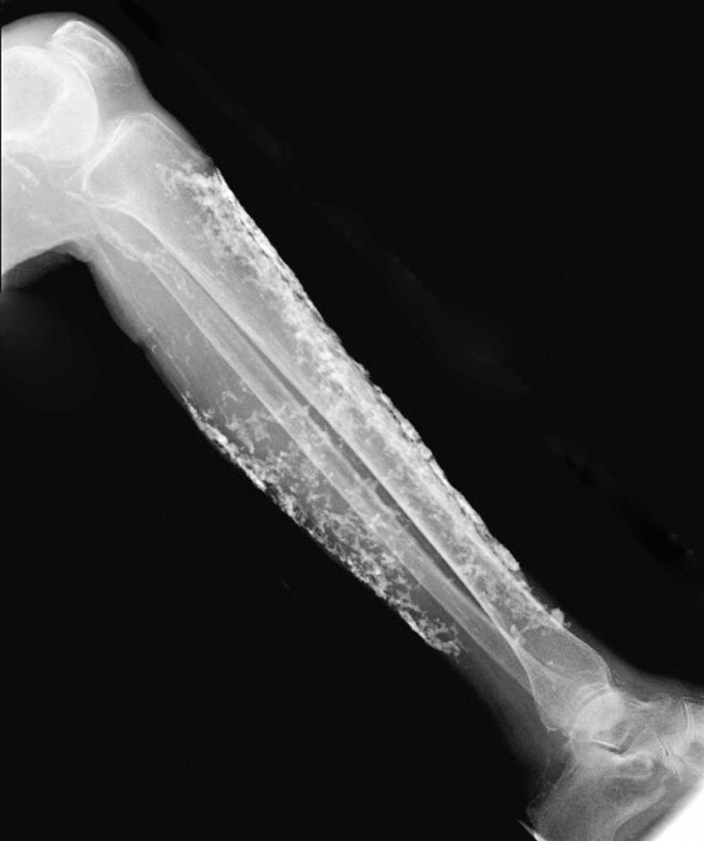 Fig. 50.2, Radiograph of calcinosis cutis in a patient with generalized morphea.