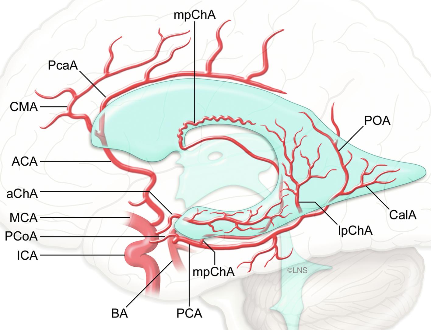 Fig. 33.2, Arterial anatomy of the periventricular region. The lateral ventricles are supplied by three choroidal arteries (the anterior choroidal artery [aChA] , medial posterior choroidal artery [mpChA] , and lateral posterior choroidal artery [lpChA] ). The aChA arises from the supraclinoid internal carotid artery (ICA) and courses underneath the optic apparatus into the temporal horn. The mpChA arises from the crural segment of P 2 (P 2 A) and wraps posteriorly around the tectum into the velum interpositum, ending in the floor of the body of the lateral ventricle through the foramen of Monro. Lastly, the lpChA arises from the ambient segment of P 2 (P 2 P) and takes a direct course into the atrium. ACA , Anterior cerebral artery; BA , basilar artery; CalA , calcarine artery; CMA , callosomarginal artery; MCA , middle cerebral artery; PCA , posterior cerebral artery; PcaA , pericallosal artery; PCoA , posterior communicating artery; POA , parieto-occipital artery.