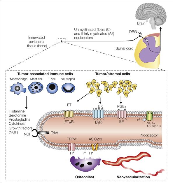 Figure 72-3, Primary afferent sensory nerve fibers and the generation and maintenance of cancer pain.