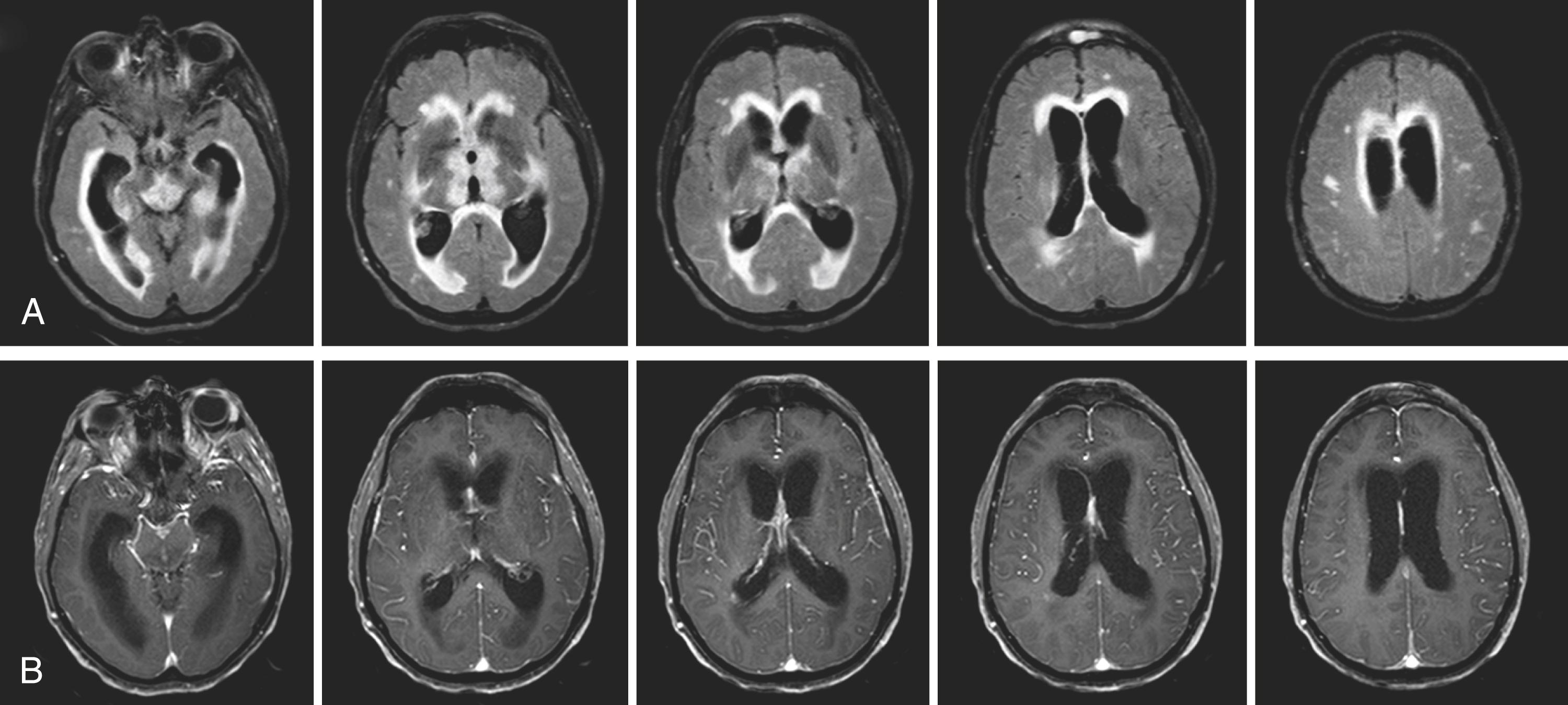 Fig. 23.1, (A) Axial MRI fluid-attenuated inversion recovery images showing increased T2 signal intensity in the dorsal midbrain, medial thalami, hypothalamus, optic tracts, anterior fornix, and periventricular white matter. Enlargement of the lateral ventricles is suggestive of obstructive hydrocephalus. (B) Axial T1 post-gadolinium MRI showing abnormal enhancement of the leptomeninges and septum pellucidum.