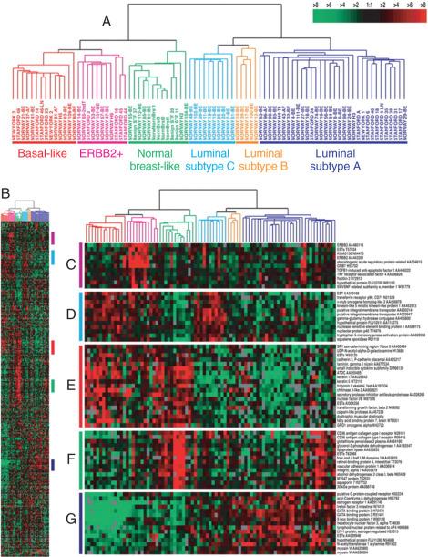 Figure 88.11, Hierarchical clustering of 115 tumor tissues and 7 nonmalignant tissues using the “intrinsic” gene set. (A) Scaled-down representation of the entire cluster of 534 genes and 122 tissue samples based on similarities in gene expression. (B) Experimental dendrogram showing the clustering of the tumors into five subgroups. Branches corresponding to tumors with low correlation to any subtype are shown in gray. (C) Gene cluster showing the ERBB2 oncogene and other coexpressed genes. (D) Gene cluster associated with luminal subtype B. (E) Gene cluster associated with the basal subtype. (F) A gene cluster relevant for the normal breastlike group. (G) Cluster of genes including the estrogen receptor (ESR1) highly expressed in luminal subtype A tumors. Scale bar represents fold change for any given gene relative to the median level of expression across all samples.