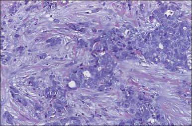 Figure 88.2, Typical infiltrating ductal carcinoma. Irregularly dispersed glands and cords of tumor cells are set in a desmoplastic stroma.