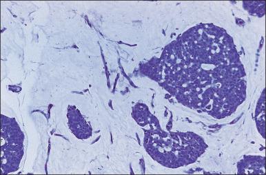 Figure 88.4, Infiltrating tubular carcinoma. The invasive glands are irregularly dispersed, lack a second myoepithelial cell layer, and are set in a desmoplastic stroma. Tubular carcinoma resembles normal breast ducts. Two normal ducts, visible in the center, appear darker than the tubular carcinoma and have two cell layers.