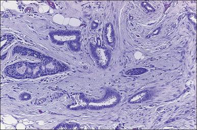 Figure 88.5, Invasive mucinous (colloid) carcinoma. Bland nests of tumor cells float in abundant extracellular mucin.