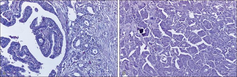 Figure 88.6, (A) Invasive carcinoma arising in papillary ductal carcinoma in situ (invasive papillary carcinoma). The in situ component shown on the right has a frondlike appearance, and the invasive carcinoma component on the left consists of irregularly shaped small glands. (B) Invasive micropapillary carcinoma of the breast. The tumor resembles ovarian serous carcinoma, and small clusters of invasive tumor cells are separated from the stroma by spaces. A psammoma body is visible.