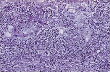 Figure 88.7, Medullary carcinoma characterized by a well-defined border, an intense lymphoplasmacytic reaction, and pleomorphic tumor cells with vesicular chromatin.