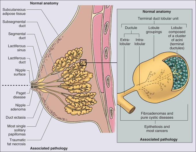 Figure 88.9, Anatomy of the breast, showing the organization of the elements of the terminal duct lobular unit and their relationship to specific pathologic abnormalities.