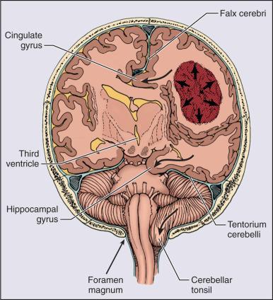 Figure 63.2, Intracranial herniation syndromes evoked by supratentorial masses. The tumor and its edema (arrows) have produced the following (curved arrows) : cingulate gyrus herniation under the falx cerebri; diencephalic herniation across the midline compressing the ipsilateral ventricle and producing the hydrocephalus in the contralateral ventricle; hippocampal gyrus herniation through the tentorial notch compressing the posterior cerebral artery and brainstem; and herniation of the cerebellar tonsils through the foramen magnum.