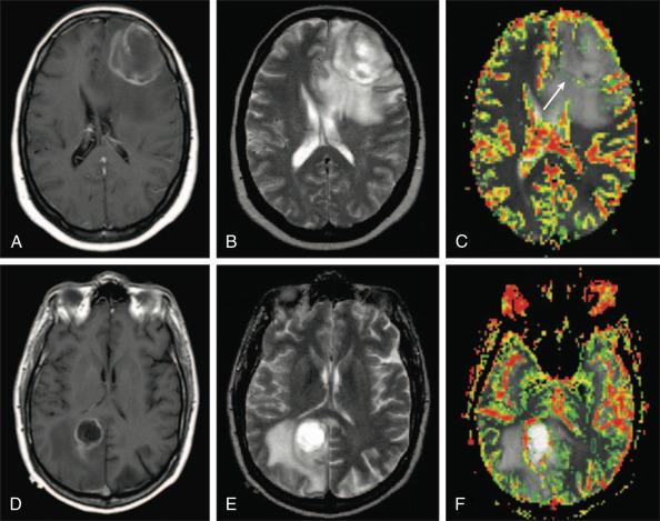 Figure 63.3, Differentiation of tumor types with perfusion magnetic resonance imaging (MRI). Axial T1-weighted postgadolinium magnetic resonance image demonstrating a metastasis from a lung carcinoma in one patient (A) and glioblastoma multiforme in another (D). Respective axial T2-weighted images demonstrate moderate edema with questionable involvement of the corpus callosum genu by the metastasis (B) and splenium of the corpus callosum by the glioblastoma (E). Perfusion magnetic resonance image demonstrates hypovascularity in the peritumoral region, with only a minor increase in perfusion at the rim of enhancing tumor (C, white arrow ), consistent with vasogenic edema without infiltrating tumor, compared with (F), which demonstrates increased perfusion in the peritumoral region, implying hypervascularity consistent with infiltrating high-grade glioma.