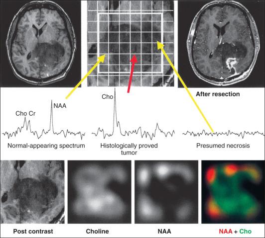 Figure 63.4, Magnetic resonance imaging/magnetic resonance spectroscopy (MRI/MRS) studies of World Health Organization grade II oligoastrocytoma. Axial T1-weighted postgadolinium MRI performed the day before surgery (top left panel) revealed an area of hypodensity that did not enhance (bottom left panel). MRS image (middle panel) shows an area of high choline ( Cho; 1.8 times greater than adjacent brain) and low N -acetylaspartate (NAA) l evels, in addition to a smaller region of no significant metabolite levels, which is presumed to be necrosis. The resection was limited to a region of elevated choline with no significant Cr, Creatine.