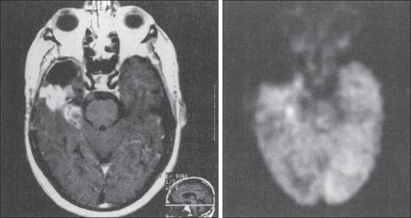 Figure 63.6, Positron emission tomography (PET) scan of recurrent glioma. The patient had undergone surgical resection of an anaplastic oligodendroglioma 15 months earlier. Areas of contrast enhancement on T1-weighted magnetic resonance imaging (MRI) scan (left) have high fluorodeoxyglucose (FDG) accumulation, consistent with recurrent high-grade tumor on the coregistered FDG-PET image (right).