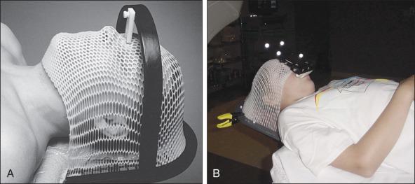 Figure 63.8, Patient immobilization devices for radiation therapy delivery. (A) Thermoplastic mask head-immobilization device. (B) Bite-block head immobilization device.