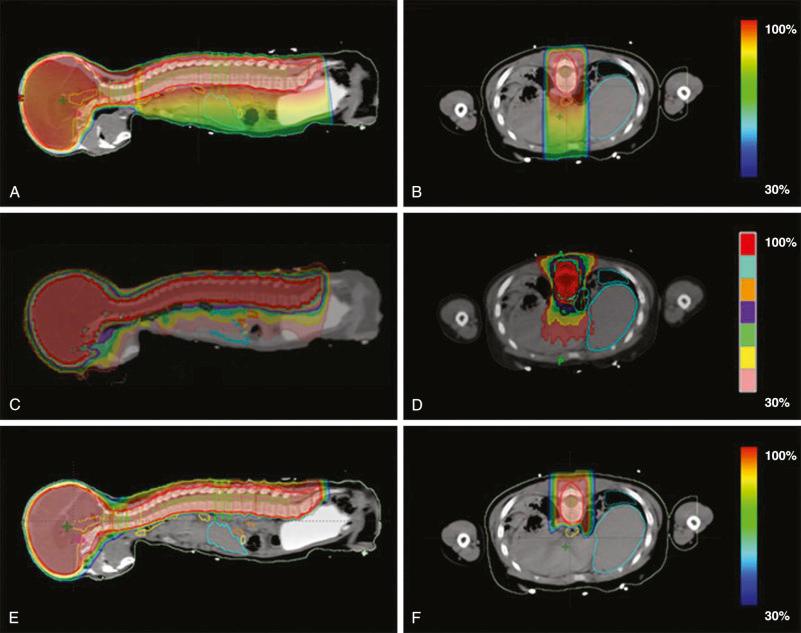 E-Figure 63.1, Sample treatment plan for craniospinal irradiation showing dose distributions in sagittal and axial views for (A–B) three-dimensional conformal radiotherapy, (C–D) tomotherapy, and (E–F) proton beam therapy.